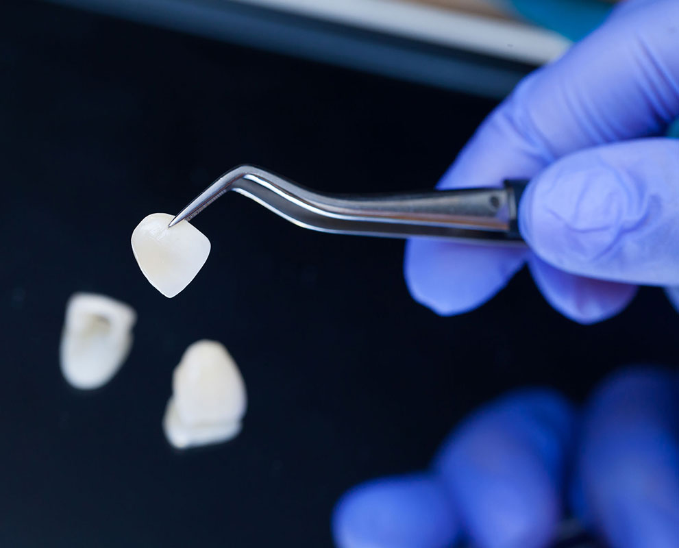 Veneer Teeth /price Kuala Lumpur Malaysia